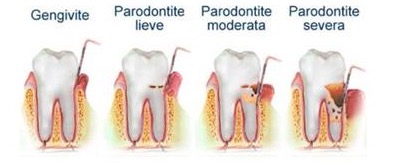 malattia-parodontale